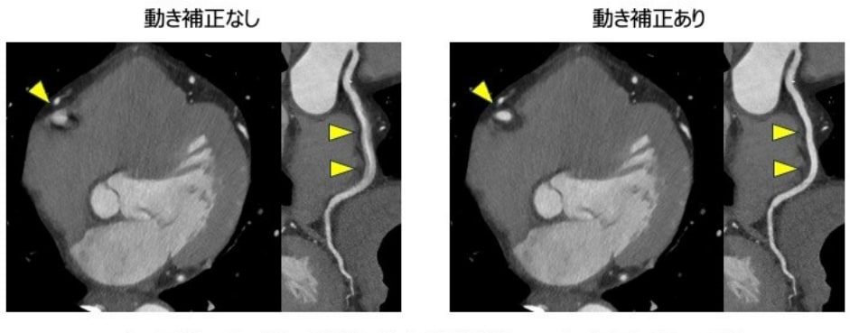 動き補正技術（CLEAR Motion Cardiac）