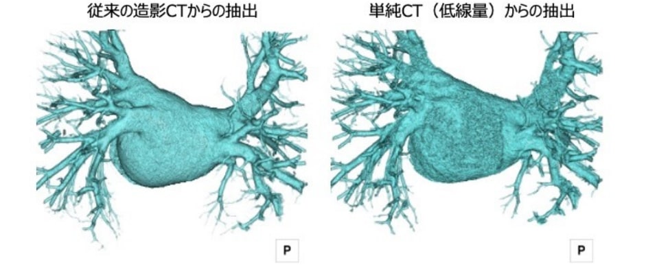 臓器の自動抽出機能：左心房と肺静脈の抽出（不整脈治療支援画像）