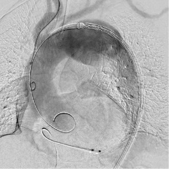 ステントグラフト挿入前