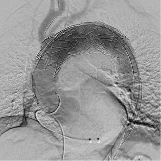 ステントグラフト挿入後