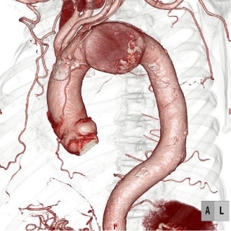 ステントグラフト挿入前CT