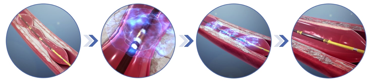 音圧波で石灰化を砕く装置と治療の流れ