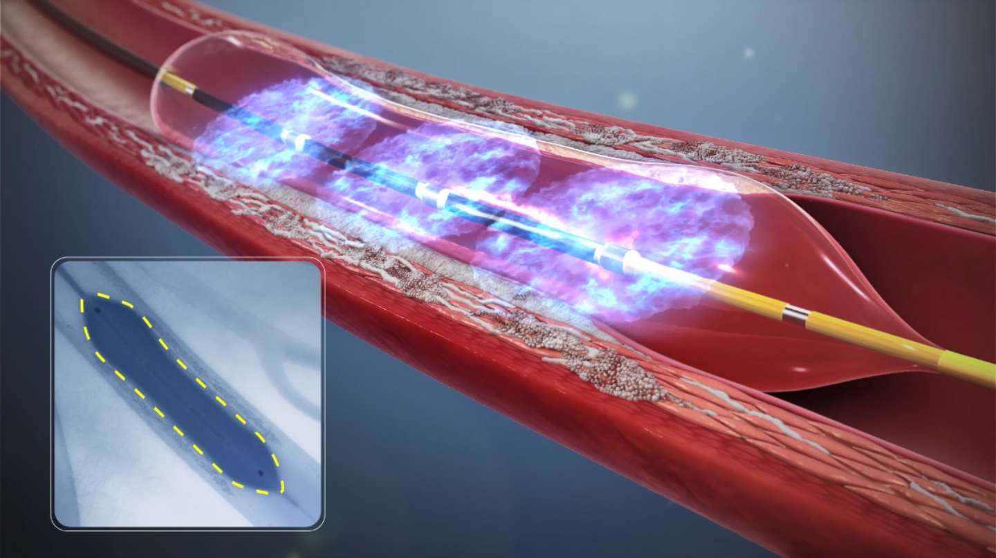 音圧波で石灰化を砕く装置と治療