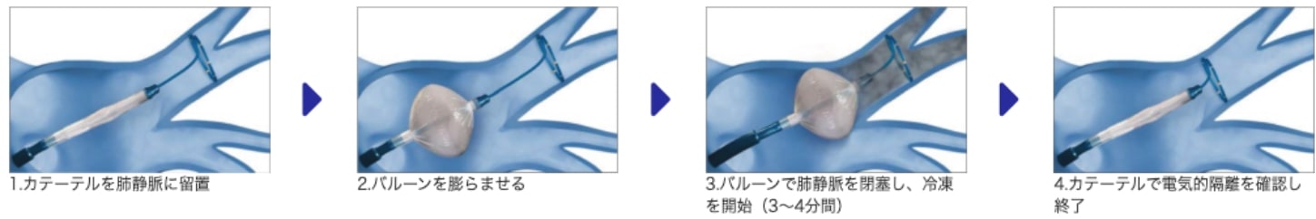 クライオアブレーション（冷凍バルーンアブレーション）
