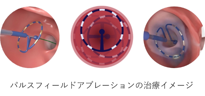パルスフィールドアブレーションの治療イメージ