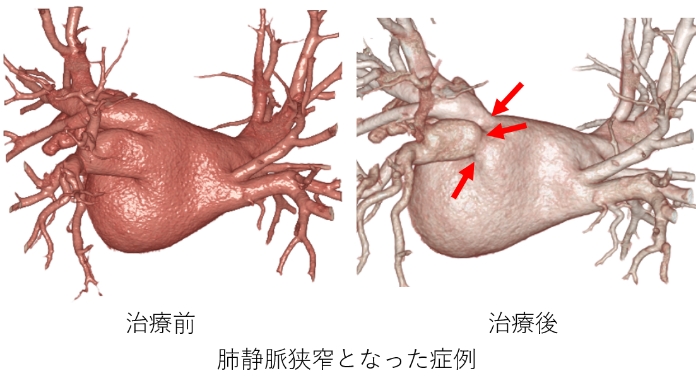 肺静脈狭窄となった症例