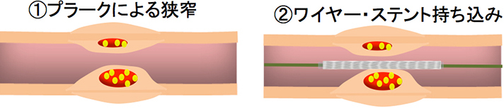 カテーテル治療1