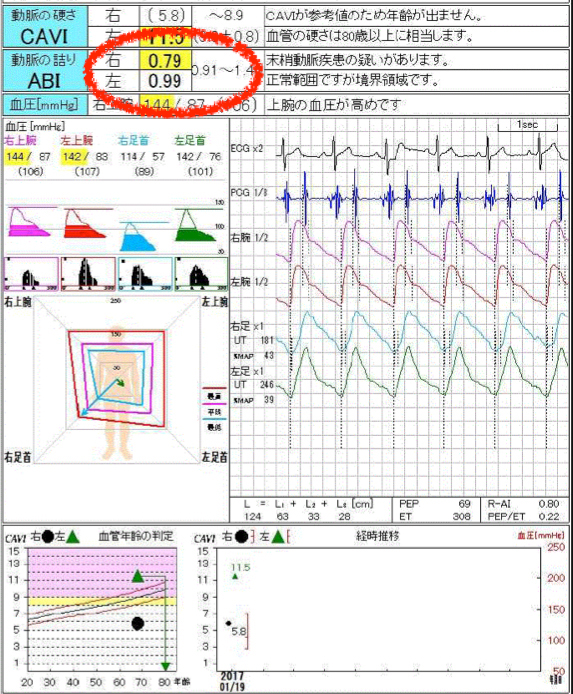 【図1】ABI検査 右足のABIが0.79に低下しています。