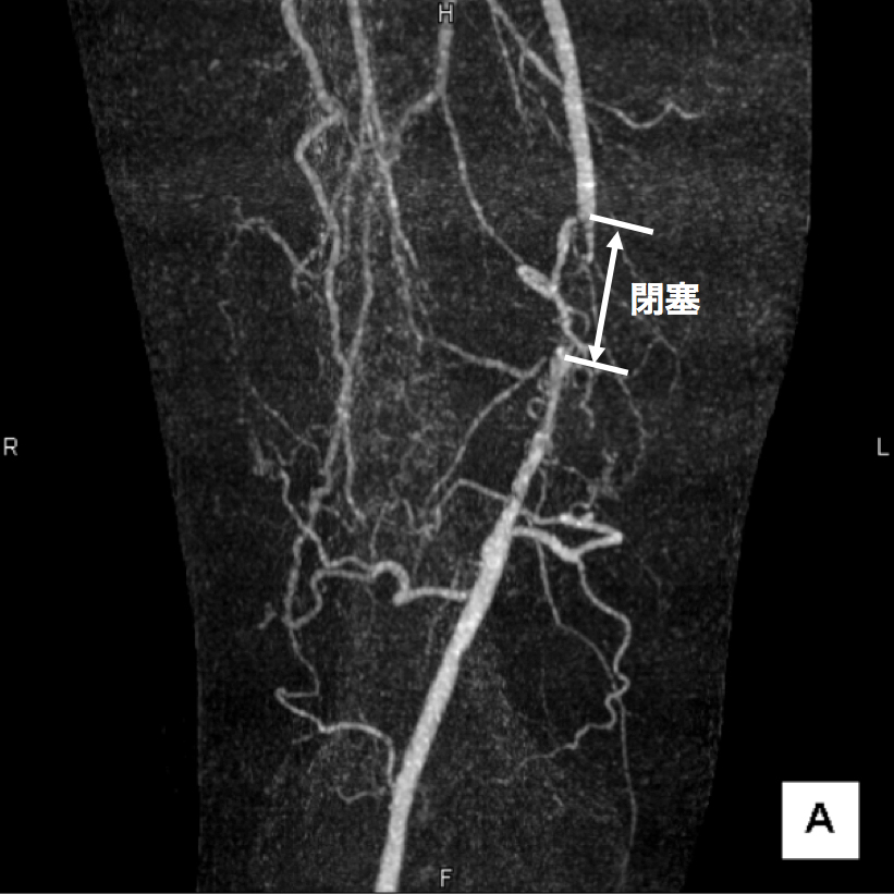 【図4】下肢造影CT検査 サブトラクションという画像の処理を行うと、血流が途絶えており、血管が完全に閉塞していることがわかります。