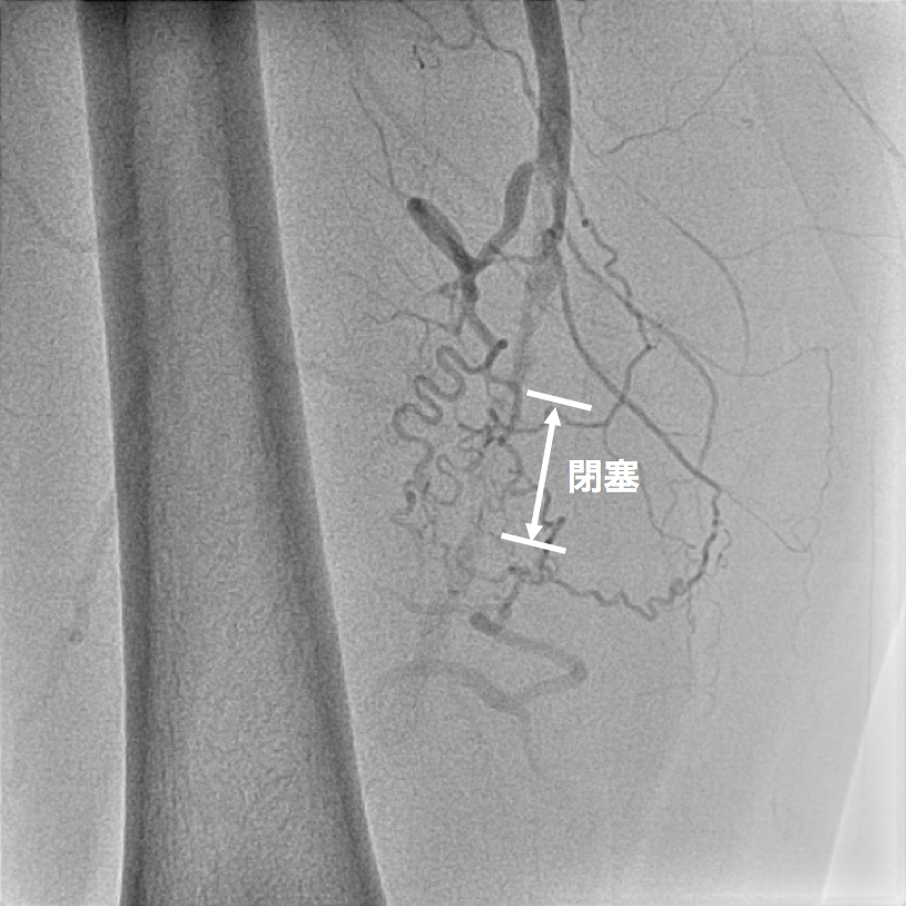 【図5】下肢造影カテーテル検査 カテーテルによる血管造影検査ですが、CT検査 同様に閉塞していることがわかります。