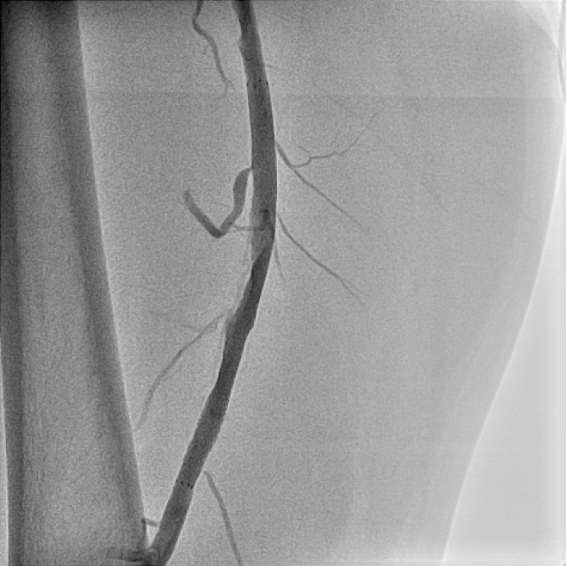 【図7】治療後ABI検査 右足のABIが1.02に改善しています。
