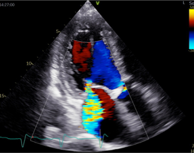 血流に色をつけて表示する技術により、速い血流や遅い血流、逆流の有無やその程度がわかります。