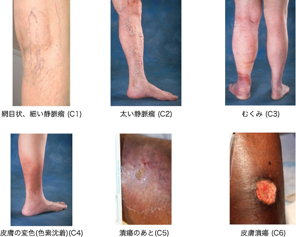 下肢静脈瘤の重症度別分類