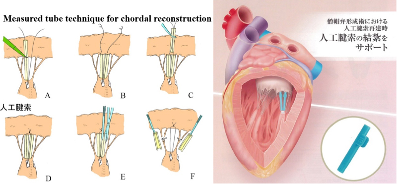 弁形成術の工夫
