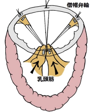 拡張型心筋症に対する僧帽弁複合体再建（PMTA法）の部分図