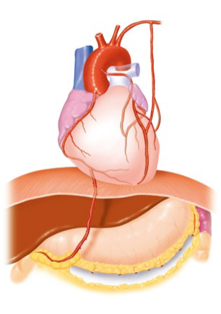 冠動脈バイパス術の例
