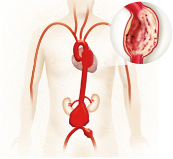 大動脈瘤に対する外科治療