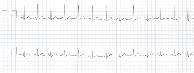 ホルター心電図