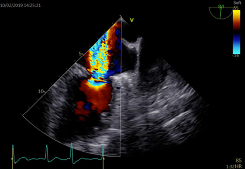経食道心エコー検査