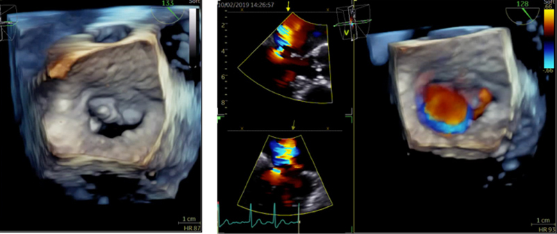 経食道心エコー検査
