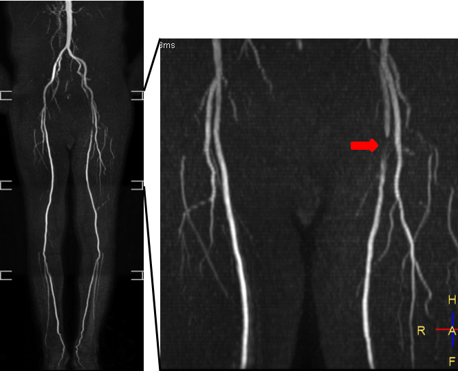 非造影下肢動脈 MRA