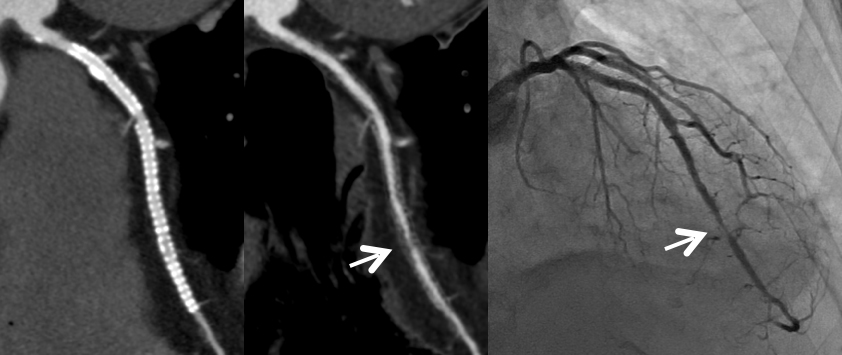 サブトラクション冠動脈CT